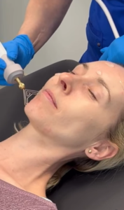 Hot plasma skin treatment Singapore — Nova Plasma Diamond tip lifting and tightening at Roses & More Skin Alchemy