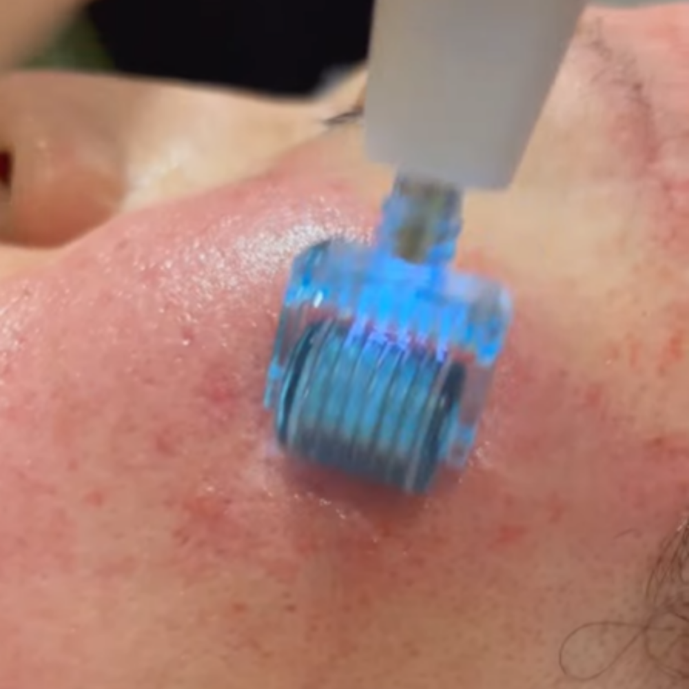 Plasma acne treatment Singapore — Acne Reset dual plasma at Roses & More Skin Alchemy Tanjong Pagar