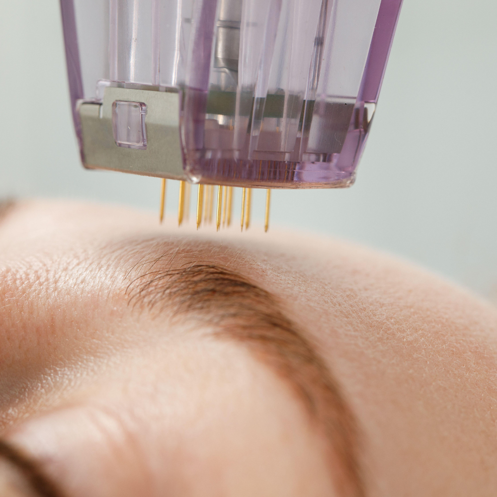 Collagen microneedling Singapore &mdash; AGE DEFY Collagen Define at Roses & More Skin Alchemy Tanjong Pagar