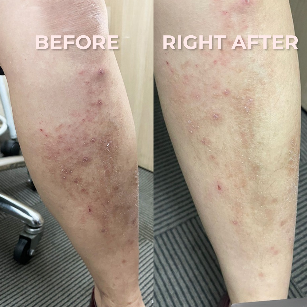 Calm & Clear eczema treatment Singapore — cold plasma for reactive, sensitive skin at Roses & More Skin Alchemy