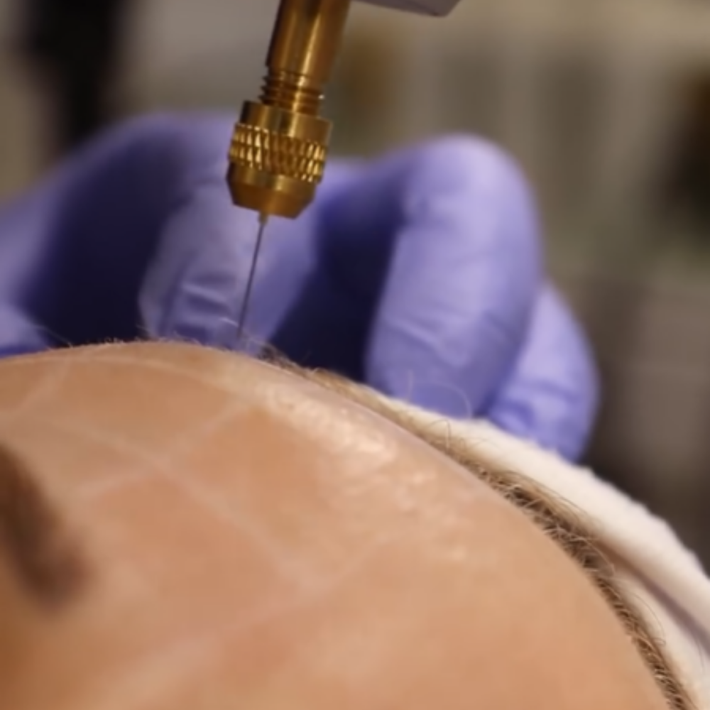 Plasma microneedling Singapore &mdash; LIFT & FIRM Deep Remodelling at Roses & More Skin Alchemy Tanjong Pagar