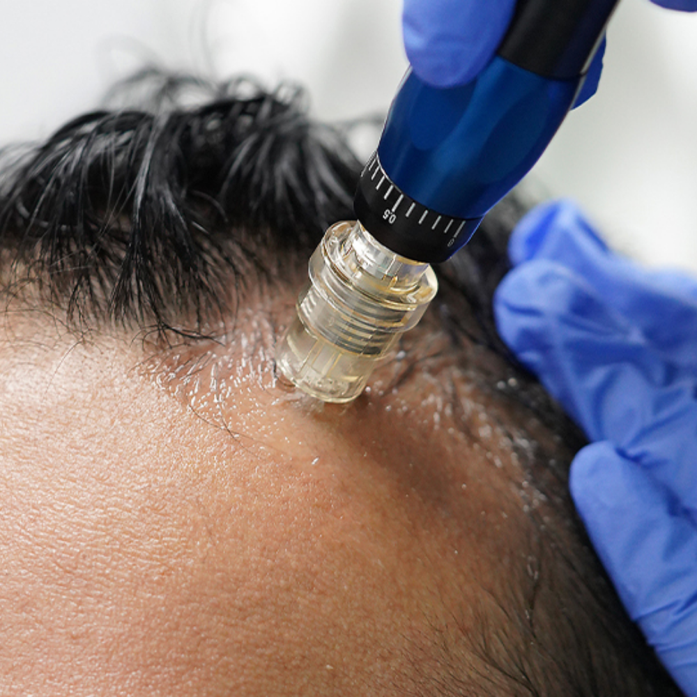 Root Revive Classic microneedling hair treatment Singapore — scalp rejuvenation at Roses & More Skin Alchemy